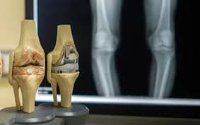 Exactech Joint Replacement