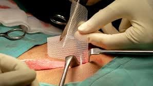 Transvaginal Mesh Complications